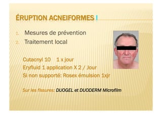 1.  Mesures de prévention
2.  Traitement local
Cutacnyl 10 1 x jour
Eryfluid 1 application X 2 / Jour
Si non supporté: Rosex émulsion 1xjr
Sur les fissures: DUOGEL et DUODERM Microfilm
 