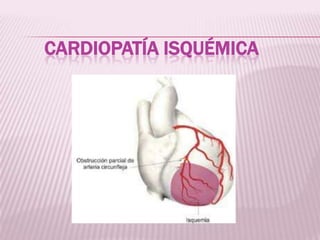 Cardiopatía isquémica 