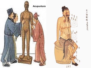 Acupuntura
 