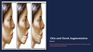 Chin and Cheek Augmentation
Source-
http://healthfirstmagazine.blogspot.com/2017/02/chin-and-
cheek-augmentation.html
 