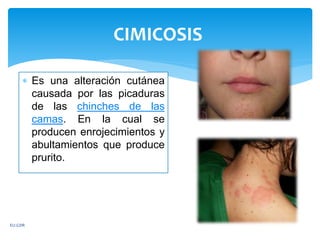  Es una alteración cutánea
causada por las picaduras
de las chinches de las
camas. En la cual se
producen enrojecimientos y
abultamientos que produce
prurito.
CIMICOSIS
EU.GDR
 