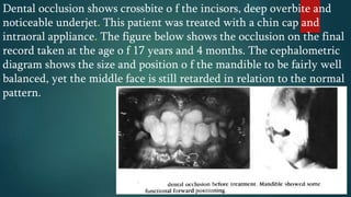 Dental occlusion shows crossbite o f the incisors, deep overbite and
noticeable underjet. This patient was treated with a chin cap and
intraoral appliance. The figure below shows the occlusion on the final
record taken at the age o f 17 years and 4 months. The cephalometric
diagram shows the size and position o f the mandible to be fairly well
balanced, yet the middle face is still retarded in relation to the normal
pattern.
 