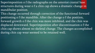 Superimposition o f the radiographs on the anterior cranial base
structures during wear o f a chin cap shows a dramatic change in
mandibular position.
This change occurred through correction of the functional forward
positioning o f the mandible. After the change o f the position,
forward growth o f the chin was more inhibited, and the chin was
displaced downward. Superimposition after discontinuation o f the
chin cap shows almost no skeletal change. The changes accomplished
during chin cap wear seemed to be retained well.
 