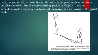 Superimposition o f the mandible on the mandibular plane at menton shows
peculiar change during the active chin cap period, with growth at the
condyle as well as the posterior border of the ramus, and a decrease in the gonial
angle.
 