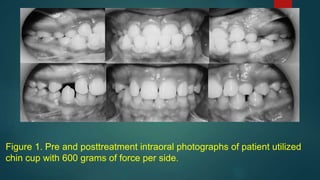 Figure 1. Pre and posttreatment intraoral photographs of patient utilized
chin cup with 600 grams of force per side.
 