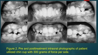 Figure 2. Pre and posttreatment intraoral photographs of patient
utilized chin cup with 300 grams of force per side.
 