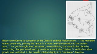 Major contributions to correction of the Class III skeletal malocclusion. 1, The mandible
rotated posteriorly, placing the ramus in a more vertical orientation to the cranial
base; 2, the gonial angle was decreased, re-establishing the mandibular plane by
overcoming changes introduced by posterior mandibular rotation; 3, vertical condylar
growth was restricted; 4, the maxilla rotated slightly in a “clockwise” direction.
 