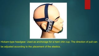 Hickam-type headgear. Used as anchorage for a hard chin cup. The direction of pull can
be adjusted according to the placement of the elastics.
 