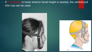 - If no increase in lower anterior facial height is desired, the vertical-pull
chin cup can be used.
 