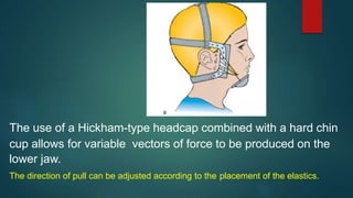 The use of a Hickham-type headcap combined with a hard chin
cup allows for variable vectors of force to be produced on the
lower jaw.
The direction of pull can be adjusted according to the placement of the elastics.
 