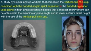 A study by Schulz and co-workers that compared the vertical-pull chin cup
combined with the bonded acrylic splint expander to the bonded expander
used alone in high-angle patients indicated that a modest improvement can
be obtained in the mandibular plane angle and in lower anterior facial height
with the use of the vertical-pull chin cup.
 