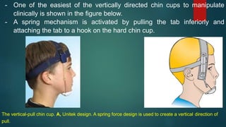 - One of the easiest of the vertically directed chin cups to manipulate
clinically is shown in the figure below.
- A spring mechanism is activated by pulling the tab inferiorly and
attaching the tab to a hook on the hard chin cup.
The vertical-pull chin cup. A, Unitek design. A spring force design is used to create a vertical direction of
pull.
 