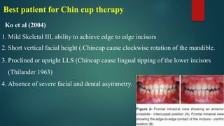Best patient for Chin cup therapy
Ko et al (2004)
1. Mild Skeletal III, ability to achieve edge to edge incisors
2. Short vertical facial height (.Chincup cause clockwise rotation of the mandible.
3. Proclined or upright LLS (Chincup cause lingual tipping of the lower incisors
(Thilander 1963)
4. Absence of severe facial and dental asymmetry.
 