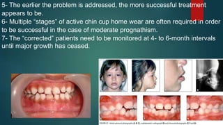5- The earlier the problem is addressed, the more successful treatment
appears to be.
6- Multiple “stages” of active chin cup home wear are often required in order
to be successful in the case of moderate prognathism.
7- The “corrected” patients need to be monitored at 4- to 6-month intervals
until major growth has ceased.
 