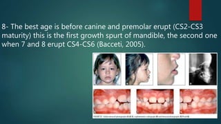 8- The best age is before canine and premolar erupt (CS2-CS3
maturity) this is the first growth spurt of mandible, the second one
when 7 and 8 erupt CS4-CS6 (Bacceti, 2005).
 