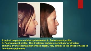 A typical response to chin-cup treatment. A, Pretreatment profile.
B, Posttreatment profile. This treatment reduces mandibular protrusion
primarily by increasing anterior face height, very similar to the effect of Class III
functional appliances.
 