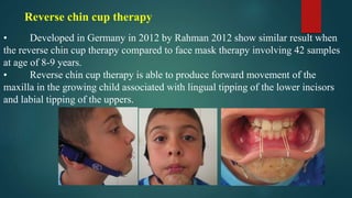 Reverse chin cup therapy
• Developed in Germany in 2012 by Rahman 2012 show similar result when
the reverse chin cup therapy compared to face mask therapy involving 42 samples
at age of 8-9 years.
• Reverse chin cup therapy is able to produce forward movement of the
maxilla in the growing child associated with lingual tipping of the lower incisors
and labial tipping of the uppers.
 