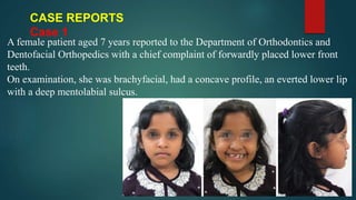 CASE REPORTS
Case 1
A female patient aged 7 years reported to the Department of Orthodontics and
Dentofacial Orthopedics with a chief complaint of forwardly placed lower front
teeth.
On examination, she was brachyfacial, had a concave profile, an everted lower lip
with a deep mentolabial sulcus.
 