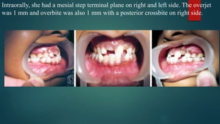 Intraorally, she had a mesial step terminal plane on right and left side. The overjet
was 1 mm and overbite was also 1 mm with a posterior crossbite on right side.
 