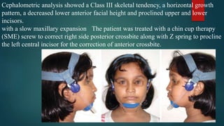 Cephalometric analysis showed a Class III skeletal tendency, a horizontal growth
pattern, a decreased lower anterior facial height and proclined upper and lower
incisors.
The patient was treated with a chin cup therapywith a slow maxillary expansion
(SME) screw to correct right side posterior crossbite along with Z spring to procline
the left central incisor for the correction of anterior crossbite.
 