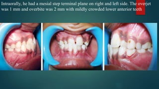 Intraorally, he had a mesial step terminal plane on right and left side. The overjet
was 1 mm and overbite was 2 mm with mildly crowded lower anterior teeth
 