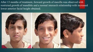 After 13 months of treatment, forward growth of maxilla was observed with
restricted growth of mandible and a normal interarch relationship with increased
lower anterior facial height obtained.
 