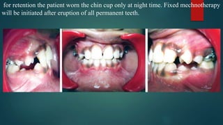 for retention the patient worn the chin cup only at night time. Fixed mechnotherapy
will be initiated after eruption of all permanent teeth.
 