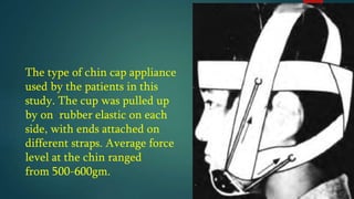The type of chin cap appliance
used by the patients in this
study. The cup was pulled up
by on rubber elastic on each
side, with ends attached on
different straps. Average force
level at the chin ranged
from 500-600gm.
 