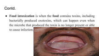 Chinese restaurant syndrome, a food poisoning case study | PPT