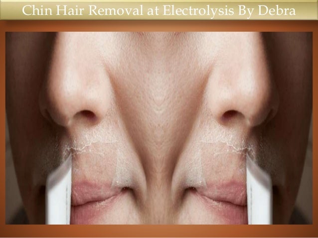 Chin Hair Removal At Electrolysis By Debra