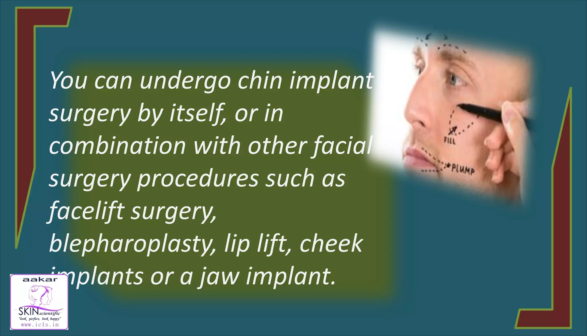 CHIN IMPLANT BY AAKAR SKIN SCIENTIFIC PPT