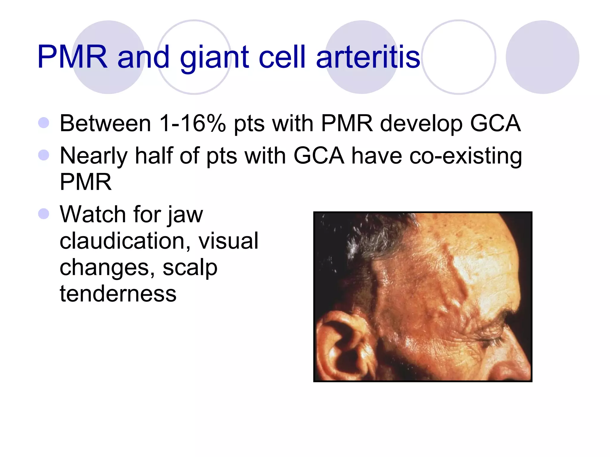 PMR and giant cell arteritis Between 1-16% pts with PMR develop GCA Nearly half of pts with GCA have co-existing PMR Watch for jaw  claudication, visual  changes, scalp  tenderness 