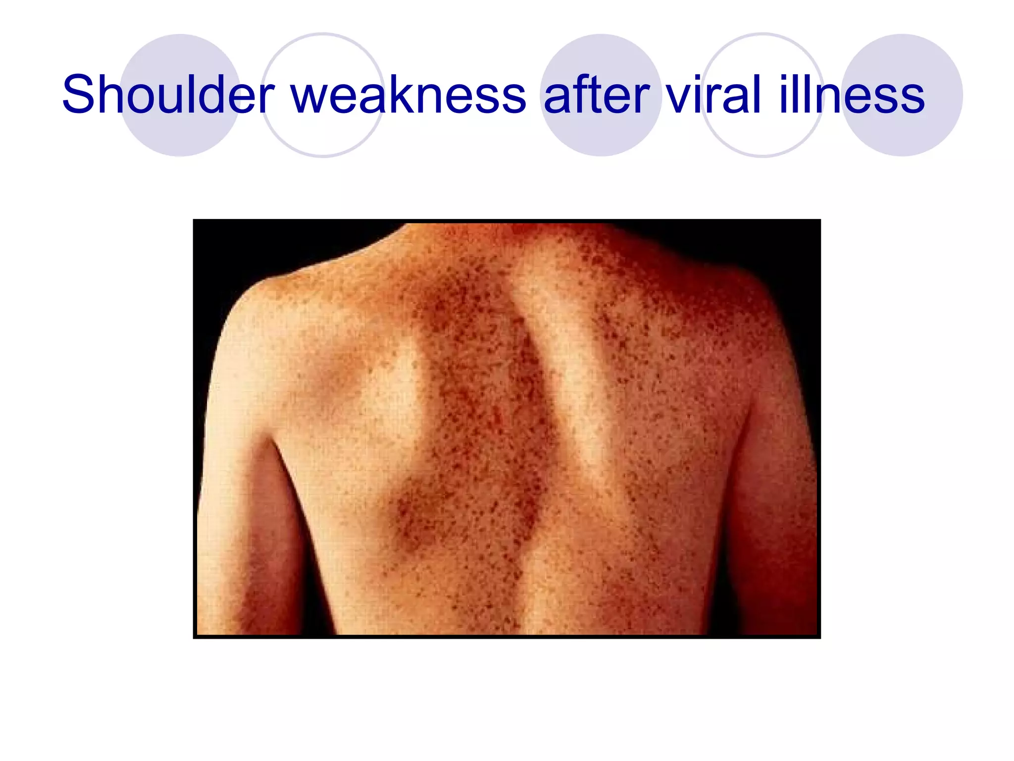 Shoulder weakness after viral illness 