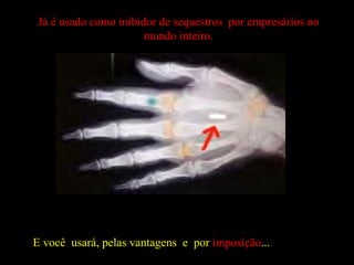 E você  usará, pelas vantagens  e  por  imposição ...  Já é usado como inibidor de sequestros  por empresários no mundo inteiro. 