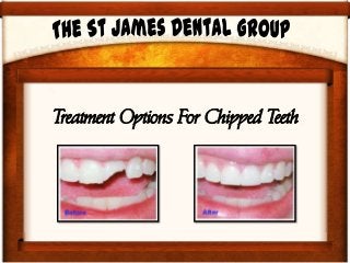 Treatment Options For Chipped Teeth
 