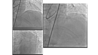 COMPLEX HIGH RISK INDICATED PERCUTANEOUS CORONARY INTERVENTION - AN ...