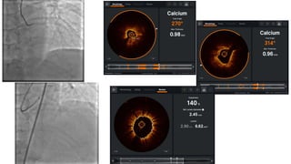 COMPLEX HIGH RISK INDICATED PERCUTANEOUS CORONARY INTERVENTION - AN ...