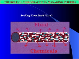 THE ROLE OF CHIROPRACTIC IN MANAGING INJURIES Swelling From Blood Vessels 