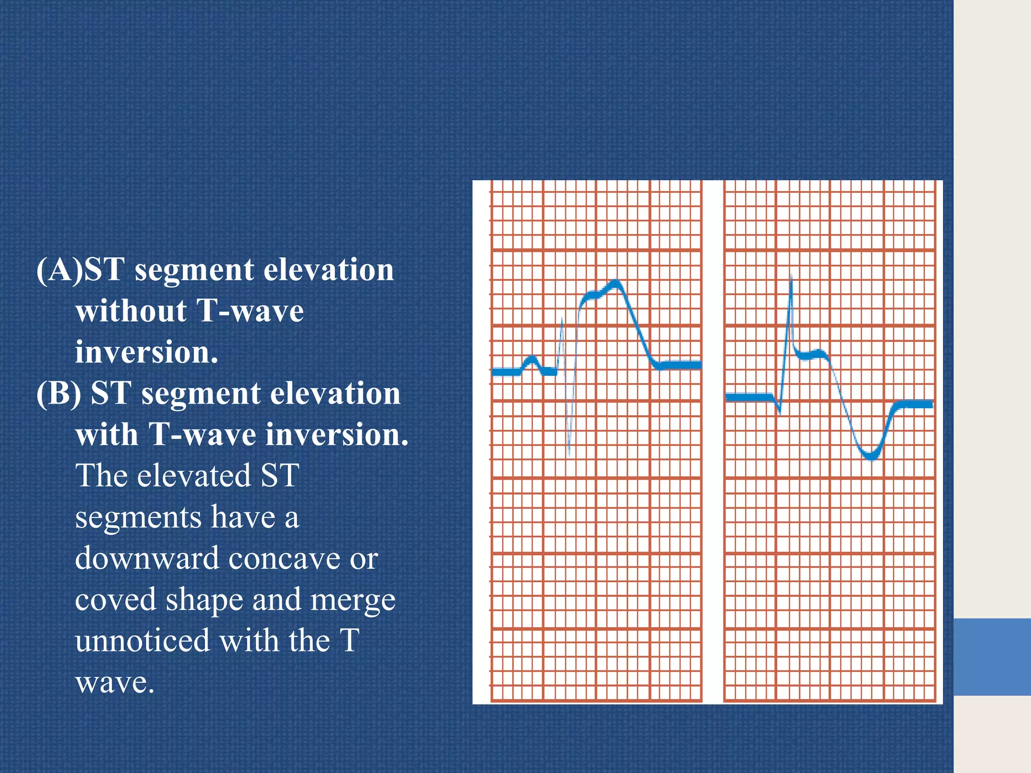 (A)ST segment elevation
without T-wave
inversion.
(B) ST segment elevation
with T-wave inversion.
The elevated ST
segments have a
downward concave or
coved shape and merge
unnoticed with the T
wave.
 