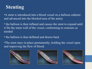 Stenting
•A stent is introduced into a blood vessel on a balloon catheter
and advanced into the blocked area of the artery
• the balloon is then inflated and causes the stent to expand until
it fits the inner wall of the vessel, conforming to contours as
needed
• the balloon is then deflated and drawn back
•The stent stays in place permanently, holding the vessel open
and improving the flow of blood.
 