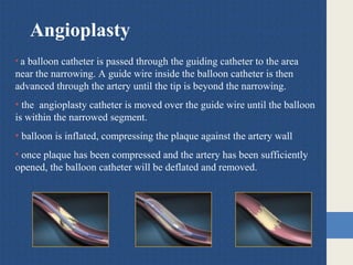 Angioplasty
• a balloon catheter is passed through the guiding catheter to the area
near the narrowing. A guide wire inside the balloon catheter is then
advanced through the artery until the tip is beyond the narrowing.
• the angioplasty catheter is moved over the guide wire until the balloon
is within the narrowed segment.
• balloon is inflated, compressing the plaque against the artery wall
• once plaque has been compressed and the artery has been sufficiently
opened, the balloon catheter will be deflated and removed.
 
