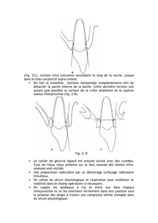 (fig. 2-C). incision intra sulculaire secondaire le long de la racine, jusque
dans le tissu conjonctif supra-crestal.
• On fait la troisième (incision horizontale complémentaire afin de
détacher la parois interne de la poche. Cette dernière incision suit
autant que possible la surface de la crête alvéolaire et le septum
osseux interproximal (fig. 2-D).
Fig. 2- D
• Le collier de gencive séparé est ensuite excisé avec des curettes.
Tous les tissus mous présents sur la face osseuse des lésions infra-
osseuses sont excisés
• Une préparation radiculaire par un détartrage surfaçage radiculaire
minutieux.
• On utilise du sérum physiologique et l'aspiration pour améliorer la
visibilité dans le champ opératoire si nécessaire.
• On coapte les lambeaux à l'os et entre eux dans l'espace
interproximal et on les maintient fermement dans leur position sous
la pression des doigts à travers une compresse stérile trempée dans
du sérum physiologique.
 