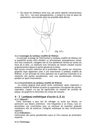• On suture les lambeaux entre eux, par points séparés interproximaux
(fig. 2-E ) . Les soins postopératoires, y compris la mise en place de
pansements, sont donnés selon les procédés déjà décrits.
(fig. 2-E )
4.2.3 Avantages du lambeau modifié de Widman
Le principal avantage de l'intervention à lambeau modifié de Widman est
la possibilité qu'elle offre d'établir un affrontement postopératoire intime
d'un tissu conjonctif, collagène sain et d'un épithélium normal sur toutes les
faces de la dent. La réattache avec formation de cément s'établit ensuite
progressivement depuis la partie apicale de la lésion
Bien qu'une certaine réduction de la profondeur des poches par rétraction
gingivale fasse également suite à une intervention à lambeau modifié de
Widman, le but principal de cette opération est la guérison maximale et la
réattache des poches parodontales, avec une parodontolyse minimale,
pendant et après l'intervention.
4.2.4 Inconvénients du lambeau modifié de Widman
Le contour gingival total paraît moins satisfaisant après l'opération à
lambeau modifié de Widman qu'après la suppression chirurgicale des poches;
cependant, l'aspect n'a pas de signification en matière de contrôle de
plaque, de gingivite et d'entretien du niveau de l'attache .
4 – 3 Lambeau esthétique d'accès (L.E.A)
4.3.1 Objectif :
Cette technique a pour but de ménager un accès aux lésions, en
particulier aux lésions antérieure très fréquentes à ce niveau, tout en
permettant une cicatrisation avec un minimum de récession gingivale
vestibulaire afin de préserver l'intégrité esthétique du bloc incisivo-canin
supérieur.
4.3.2 Indications :
l'élimination des poche parodontales supra et infra osseuse de profondeur
moyenne.
4.3.3 Technique
 