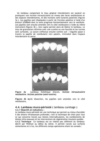 Un lambeau comportant le tissu gingival interdentaire est soulevé en
pratiquant une incision intrasulculaire au niveau des faces vestibulaires et
des espaces interdentaires, et des incisions semi-lunaires palatines (figures
3a ). Les papilles sont disséquées à partir de l'incision palatine à l'aide d'un
bistouri d'ORBAN dont la lame progresse horizontalement vers le vestibule.
Les papilles sont ensuite amenées vers le côté vestibulaire à l'aide du même
instrument (figures 3b ). Une rugine permet alors de libérer le lambeau. Le
tissu de granulation s'élimine avec une curette ou une faucille et les racines
sont surfacées. La suture s'effectue ensuite comme suit : l'aiguille passe à
travers la papille de vestibulaire vers palatin, s'introduit dans l'espace
interdentaire et perce
Figure 3a Lambeau Esthétique d'Accès. Incision intrasulculaire
vestibulaire. Incision palatine (semi-lunaire).
Figures 3b Après dissection, les papilles sont amenées vers le côté
vestibulaire,
4.4. Lambeau muco-périosté ( lambeau curetage )
4.4.1 Objectifs et indications :
Le lambeau muco-périosté est une technique qui permet au mieux d'accéder
à des lésions infraosseuses profondes, c'est la technique de choix pour tout
ce qui concerne l'accès aux lésions interradiculaires, les comblements de
lésions infra-osseuses et les interventions de régénération tissulaire guidée.
4.4.2 Technique Ce lambeau est en réalité peu différent du lambeau
décrit par Widman au début du siècle. Il permet l'accès aux surfaces
cémentaires et à l'os, les différents temps opératoires étant les suivants :
 