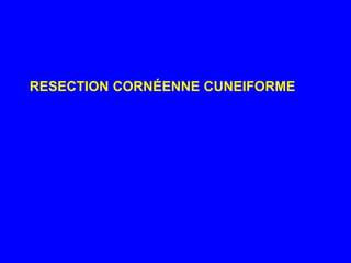 RESECTION CORNÉENNE CUNEIFORME