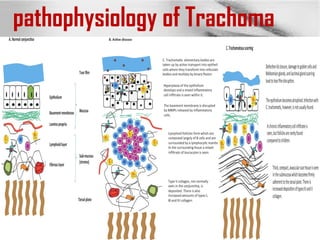 pathophysiology of Trachoma
 