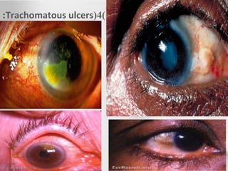 )4(Trachomatous ulcers:
 