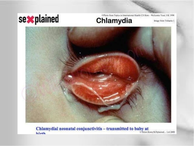 Chlamydia Conjunctivitis