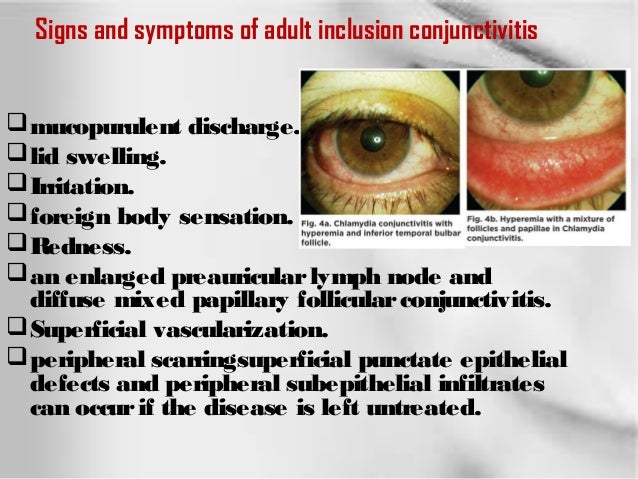 Treatment Of Gonococcal Conjunctivitis In Adults