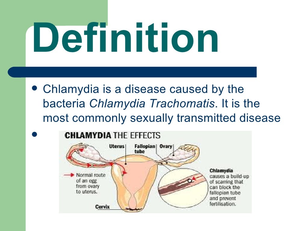 Chlamydia Infection